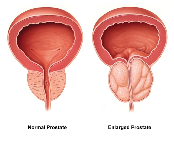 Prostate Gel